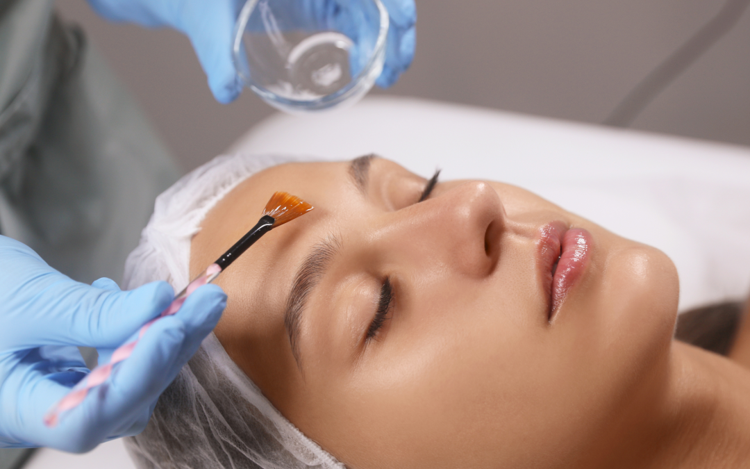 Chemical Peels Explained Are They Right for You