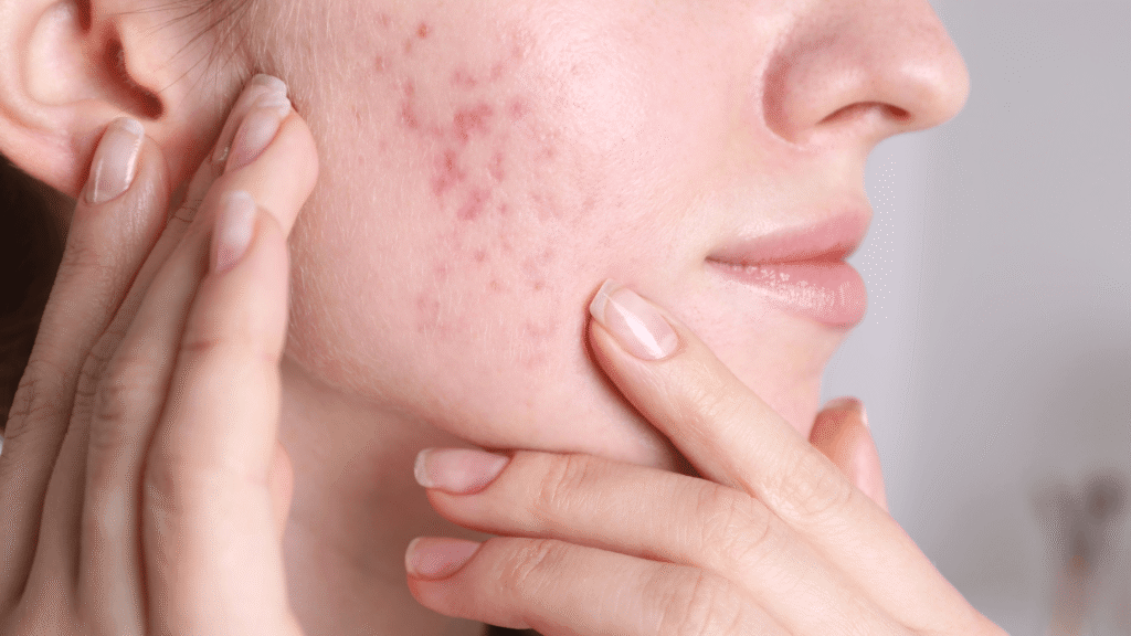 Acne & Hormones_ Why Breakouts Happen