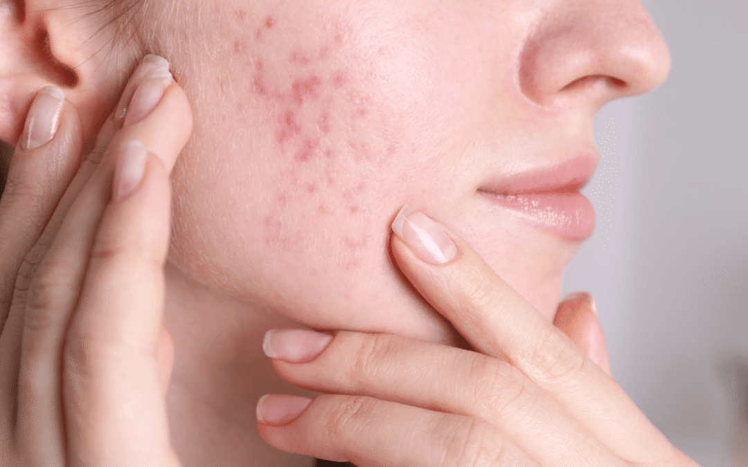 Acne & Hormones_ Why Breakouts Happen