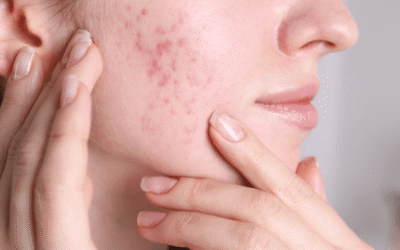 Acne & Hormones: Why Breakouts Happen